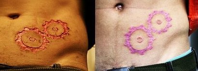 Jizvy těsně po zákroku a po zahojení.