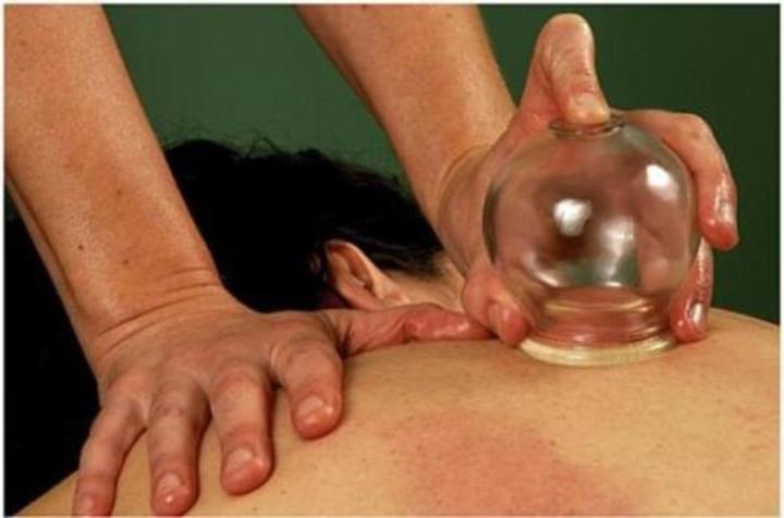 Fotografie znázorňující baňkování