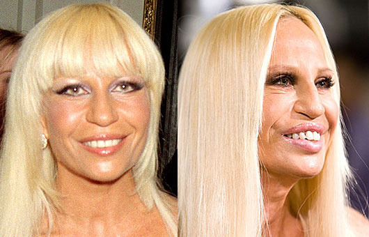 Donatella Versace před a po plastice (plastic-celebrity-surgery.blogspot.com) Donatella Versace před a po plastice (plastic-celebrity-surgery.blogspot.com)